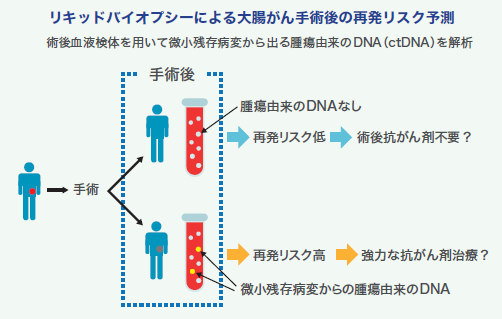 リキッドバイオプシーによる大腸がん手術後の再発リスク予測
