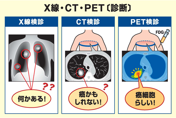 X線_CT_PET