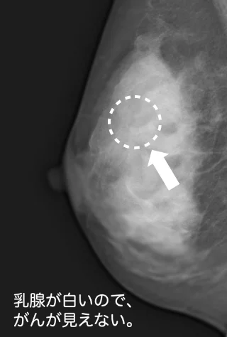 マンモグラフィ