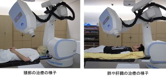 肺や肝臓へのサイバーナイフ治療
